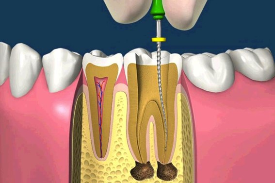 Trattamenti di Endodonzia Brescia